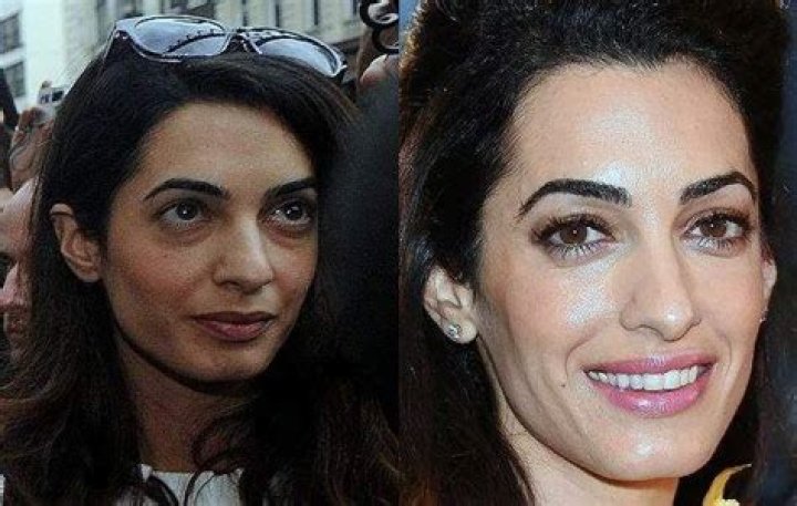 Amal Clooney Plastic Surgery | Before And After Photos