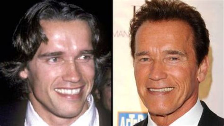 Arnold Schwarzenegger’s Plastic Surgery: Botox, Jaw Reduction, Eyelid Surgery & Fillers!