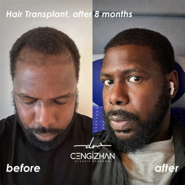 Did Peyton Manning Have Hair Transplant? Big Forehead Has Always Brought Him Luck