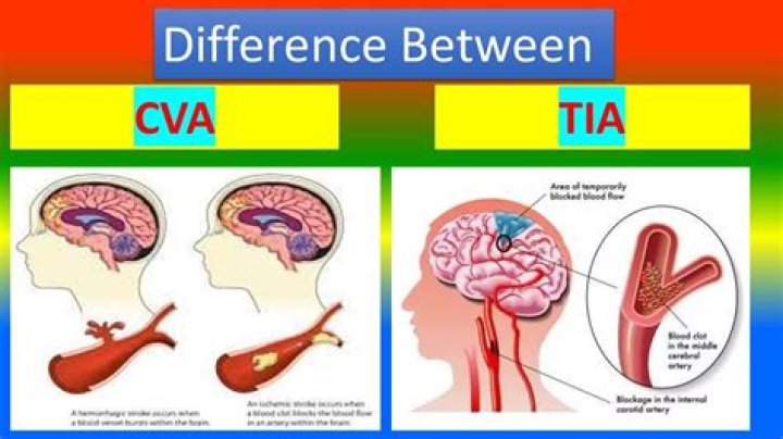 Difference between cva and tia