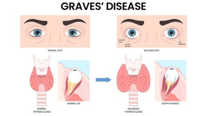 Echoes: Karen Robinson Eyes Problems – Does She Have A Graves Disease?