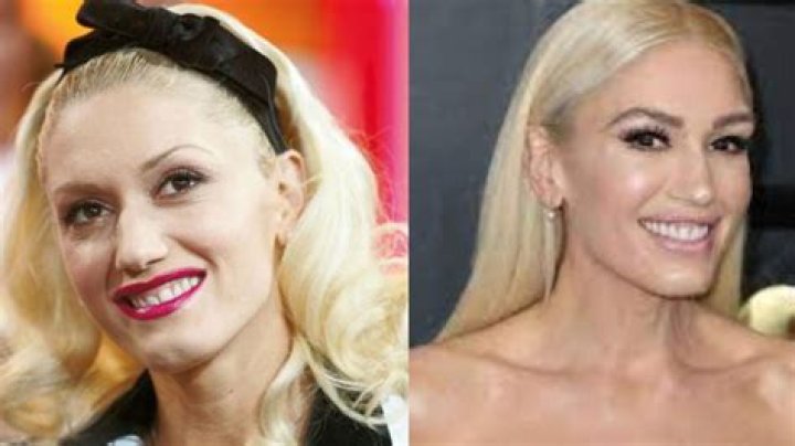 Gwen Stefani’s Plastic Surgery: Reddit Discussions About Botox, Nose Job, and More; The Singer Then and Now!
