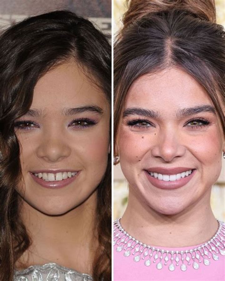 Hailee Steinfeld Plastic Surgery: Did She Get A Nose Job? Her Secret To Weight Loss Revealed