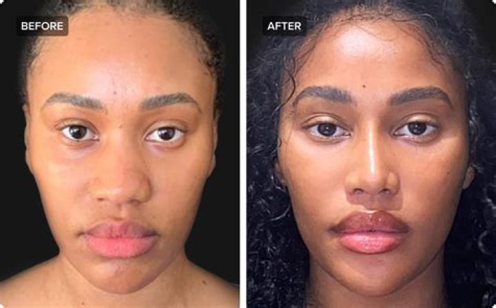 Has Anya Chalotra Had A Nose Job? Plastic Surgery Rumors Of The Witcher Season 2 Star Explained