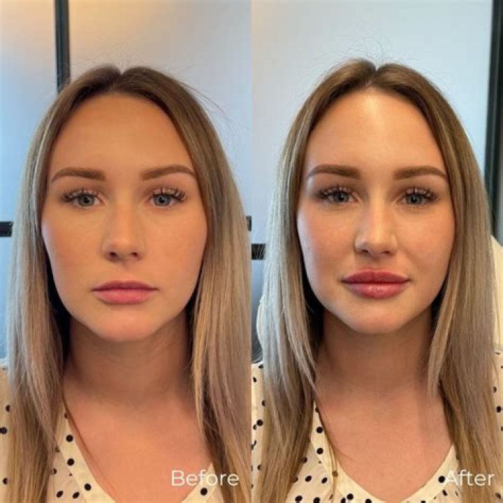 Mackenzie Ziegler Nose Job Botox And Lip Filler Before And After Photos