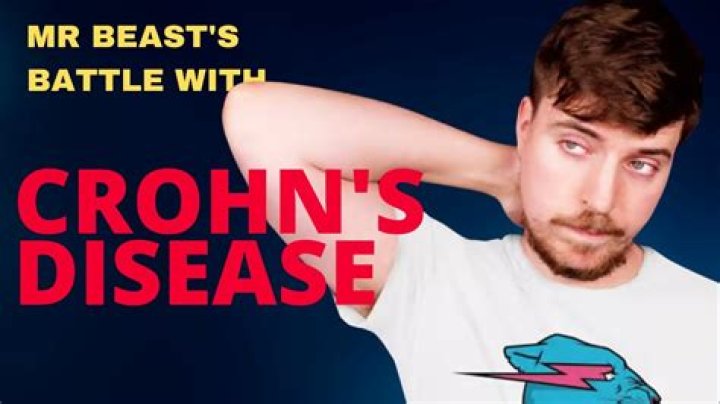 Mr Beast Crohn Disease Led To Death Hoax, Your Favorite YouTuber Is Alive and Well