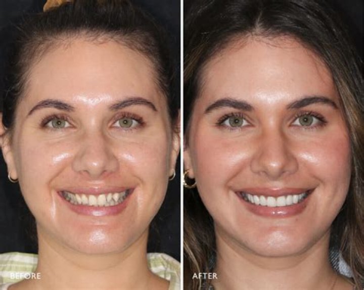 Nany Gonzalez Before And After Veneers Transformation Is Astonishing