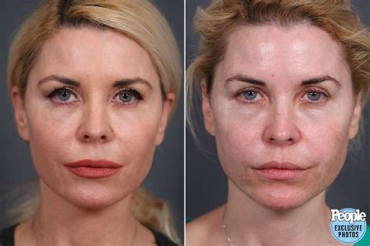 What Happened To Dane Cook’s Face: Has He Done Face Lift And Botox Surgery