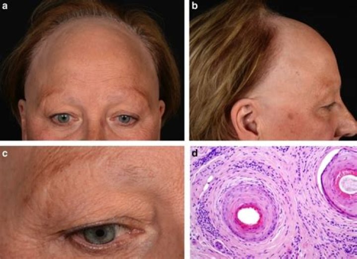 What Happened To Nick Kyrgios Brother Christos Kyrgios Hair? Alopecia Update, Is He Still Sick?