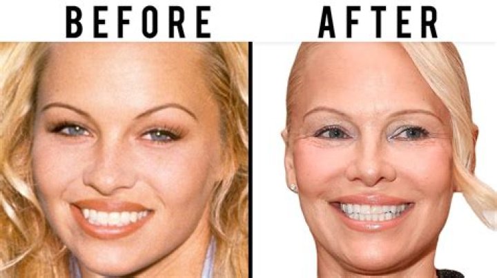 What Happened To Pam Hupp Neck? Facelift Story On Dateline Episode