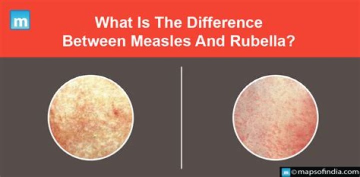What is the Difference Between Measles and Rubella