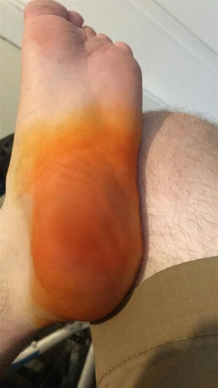 Why are my feet orange